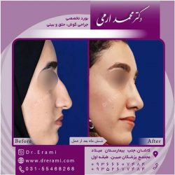 جراحی-بینی-کاشان-111