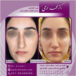 جراحی-بینی-کاشان-112