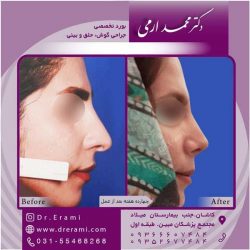 جراحی-بینی-کاشان-113