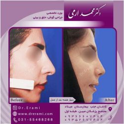 جراحی-بینی-کاشان-114