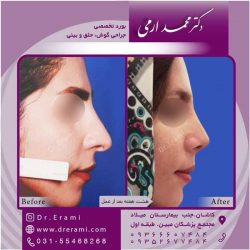جراحی-بینی-کاشان-115