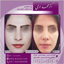 جراحی-بینی-کاشان-116