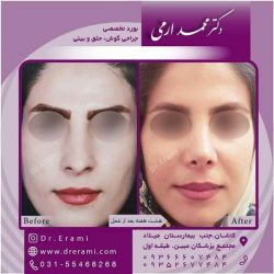 جراحی-بینی-کاشان-117