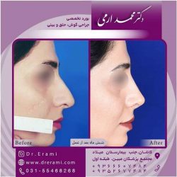 جراحی-بینی-کاشان-120