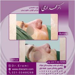 جراحی-بینی-کاشان-122