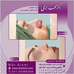 جراحی-بینی-کاشان-123