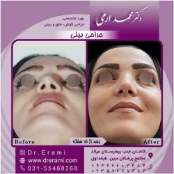 جراحی-بینی-کاشان-124