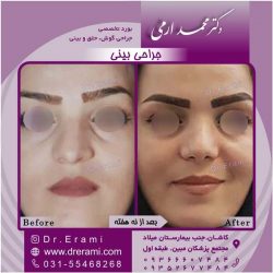 جراحی-بینی-کاشان-125