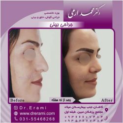 جراحی-بینی-کاشان-126