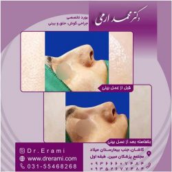 جراحی-بینی-کاشان-127