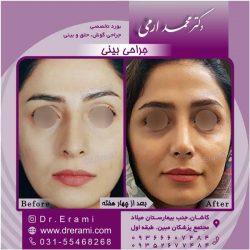جراحی-بینی-کاشان-128