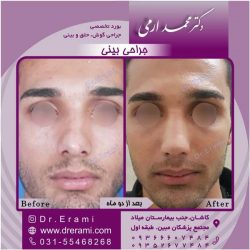 جراحی-بینی-کاشان-132