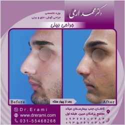 جراحی-بینی-کاشان-134