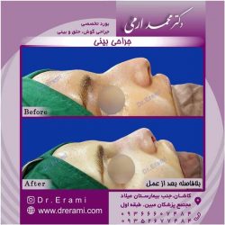 جراحی-بینی-کاشان-135