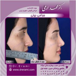 جراحی-بینی-کاشان-136