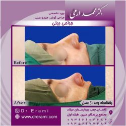 جراحی-بینی-کاشان-137