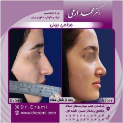 جراحی-بینی-کاشان-138