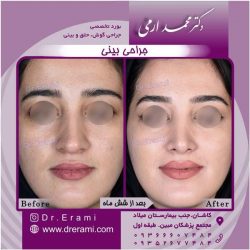 جراحی-بینی-کاشان-139