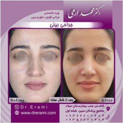 جراحی-بینی-کاشان-140