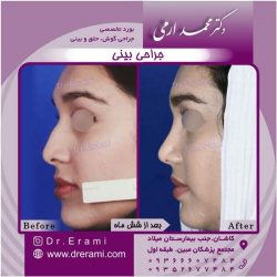 جراحی-بینی-کاشان-141