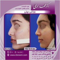 جراحی-بینی-کاشان-142