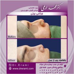 جراحی-بینی-کاشان-143