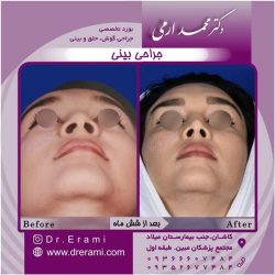 جراحی-بینی-کاشان-144