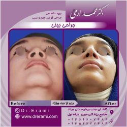 جراحی-بینی-کاشان-145