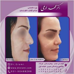 جراحی-بینی-کاشان-147