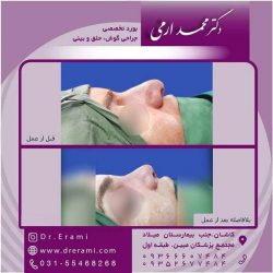 جراحی-بینی-کاشان-148