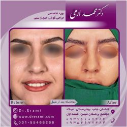 جراحی-بینی-کاشان-82
