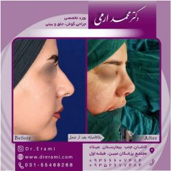 جراحی-بینی-کاشان-83