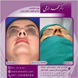 جراحی-بینی-کاشان-84