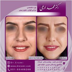 جراحی-بینی-کاشان-85