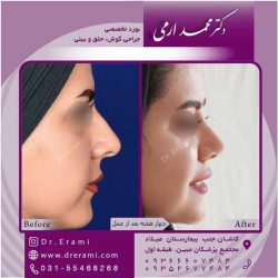 جراحی-بینی-کاشان-86
