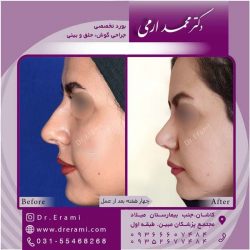 جراحی-بینی-کاشان-87