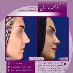 جراحی-بینی-کاشان-88