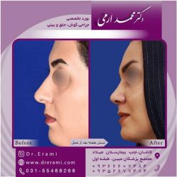 جراحی-بینی-کاشان-89