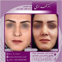 جراحی-بینی-کاشان-90