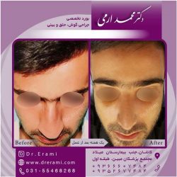 جراحی-بینی-کاشان-91
