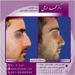 جراحی-بینی-کاشان-92
