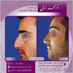 جراحی-بینی-کاشان-93