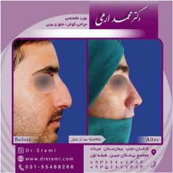 جراحی-بینی-کاشان-94