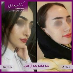 جراحی-بینی-کاشان-96