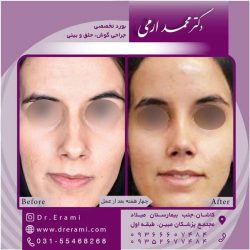 جراحی-بینی-کاشان-97