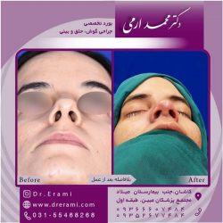 جراحی-بینی-کاشان-98