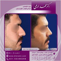 جراحی-بینی-کاشان-99