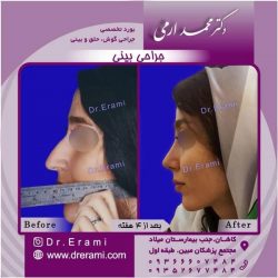 جراحی-بینی-10