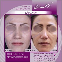 جراحی-بینی-100