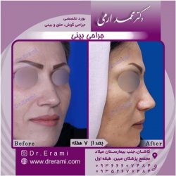 جراحی-بینی-101